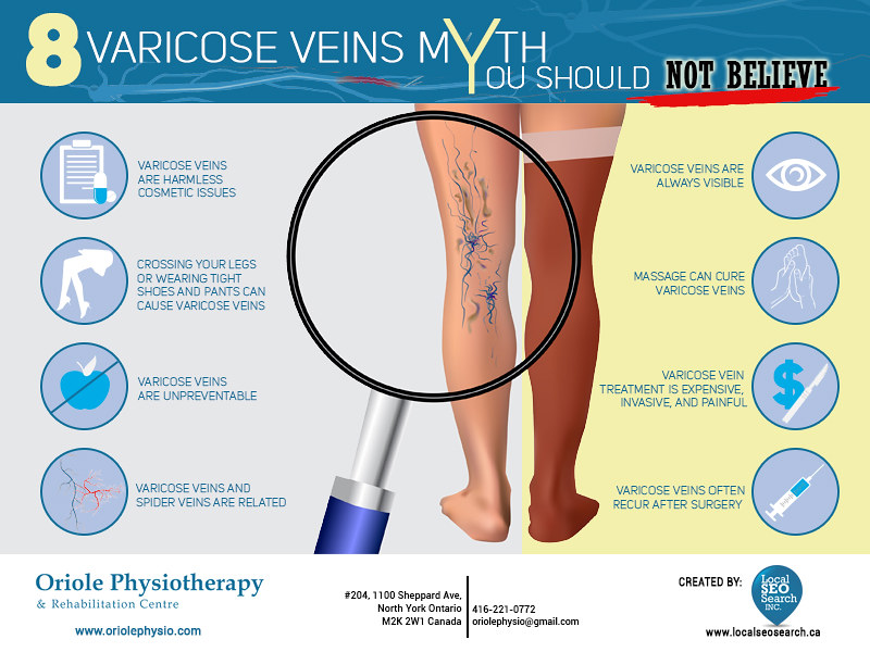 Venas varicosas y síndrome de las piernas: cómo evitarlas y qué hacer al respecto