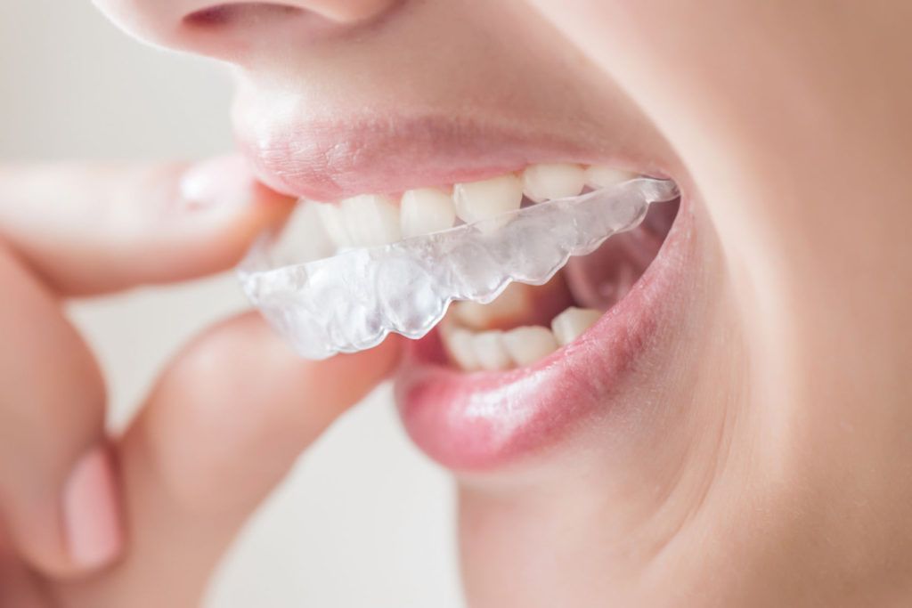 Blanqueamiento dental: Qué es, cómo hacerlo y cuándo utilizarlo